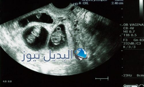 متى يظهر كيس الحمل بتوأم