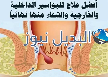 طرق طبيعية للتخلص من البواسير نهائياً