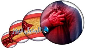 أعراض إرتفاع الكوليسترول في الدم