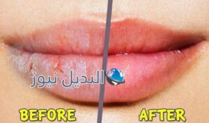 علاج تشقق الشفايف وتوريدها بالمنزل