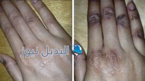 تبييض اليدين وازالة سواد السنين