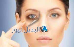 إزالة الهالات السوداء تحت العين