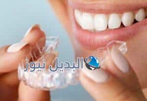 تبييض الأسنان المنزلي بالقوالب