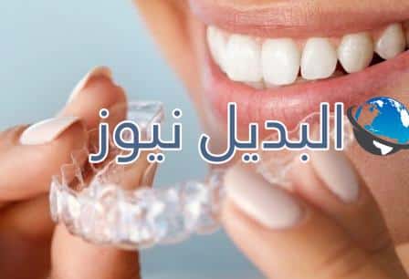 تبييض الأسنان المنزلي بالقوالب