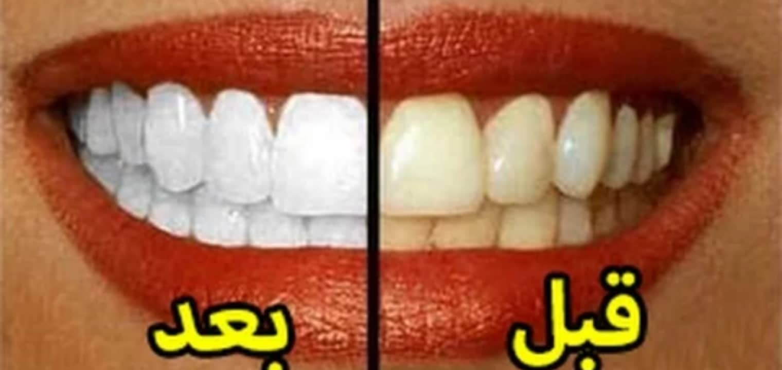 طريقة تبييض الاسنان في يوم واحد