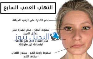 أعراض إلتهاب العصب السابع