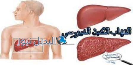 المرضى المصابين بالتهاب الكبد