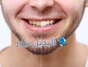 تأثير التدخين على الأسنان وحدوث التصبغات