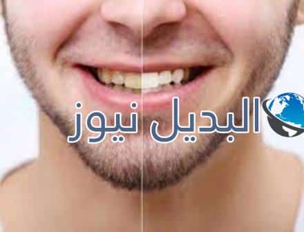 تأثير التدخين على الأسنان وحدوث التصبغات