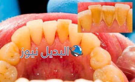 المنتجات الطبيعية لإزالة الجير
