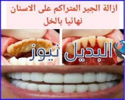دور الخل والملح في إزالة الجير بالأسنان