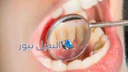 كيف اتخلص من الجير في الاسنان في المنزل