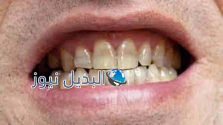 كيف ازيل تصبغات الأسنان