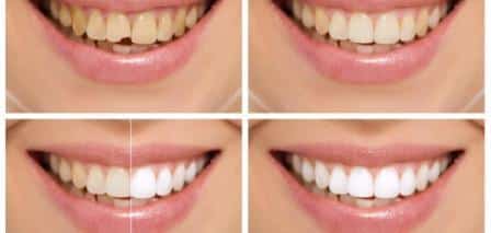 اسناني صفراء كيف ابيضها